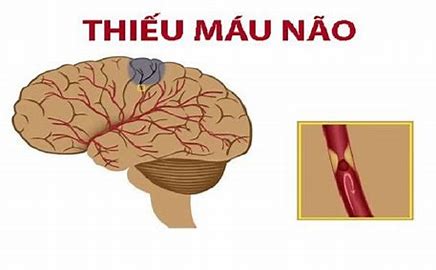 Các triệu chứng thiếu máu não và cách khắc phục